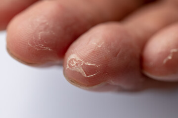 Pattern of Atopic eczema and fungal diseases on the human body.