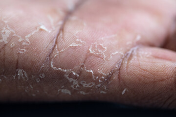 Fototapeta premium Pattern of Atopic eczema and fungal diseases on the human body.