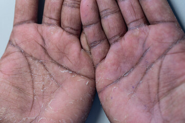 Pattern of Atopic eczema and fungal diseases on the human body.