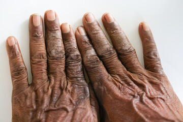 Pattern of Atopic eczema and fungal diseases on the human body.
