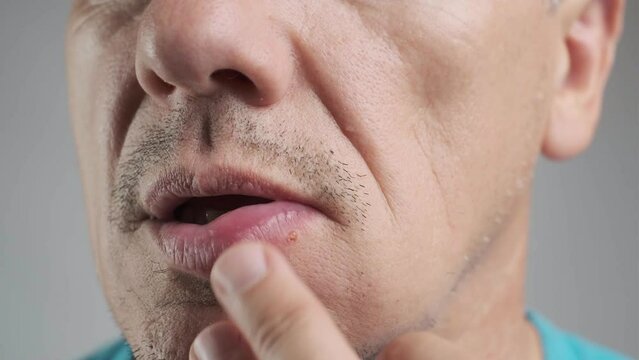 Allergic reaction to a bee sting. An unshaven man was stung by a bee and touches his face in the stung area close-up. Edema, swelling of the lower lip