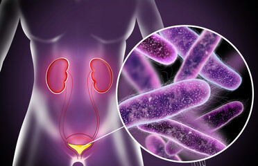 Illustration of woman suffering from cystitis. Urinary infection
