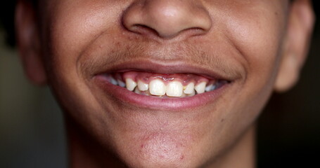 Fototapeta premium Pre-teen young boy smiling, close-up child mouth teeth