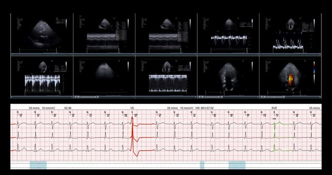 This is a screenshot view of an echo heart transthoracic cardiogram ultrasound screen that is examining the heart on a digital tablet in clinic