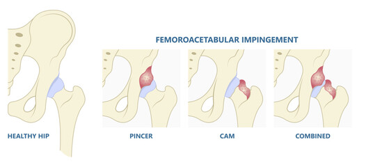Types of hip bone Pain range of motion with head tear groin Treat joint thigh femur injury spurs socket lesion