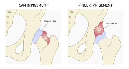 Impigement syndrome of hip bone Pain range of motion with head tear groin Treat joint thigh femur injury spurs socket lesion