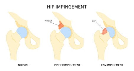 Impigement syndrome of hip bone Pain range of motion with head tear groin Treat joint thigh femur injury spurs socket lesion - obrazy, fototapety, plakaty