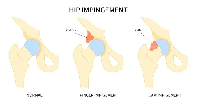 Impigement syndrome of hip bone Pain range of motion with head tear groin Treat joint thigh femur injury spurs socket lesion