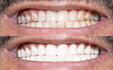 Close-up Of A Smiling human's Teeth Before And After Whitening
