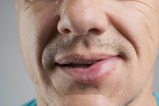 Allergic reaction to a bee sting. An unshaven man was stung by a bee. Edema, swelling of the lower lip in the stung area close-up