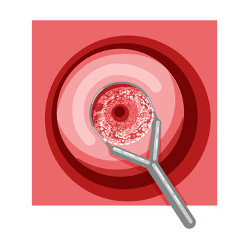 recommend clip art: Electrocoagulation diathermy of the cervical dysplasia cancer infographic Female reproductive system Carcinoma uterus. Front view in cut. Human anatomy internal organs location scheme flat style icon