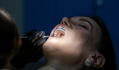 Installing a retainer after wearing braces. The process of removing braces.Beautiful woman in dental chair during procedure of installing braces to upper and lower teeth. Dentist and assistant working - obrazy, fototapety, plakaty