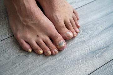 male man feet close up, nail fungus, skin and nail infection, toe mycosis, treatment needed, fungal infection concept, onychomycosis  © Anna Ivanovska