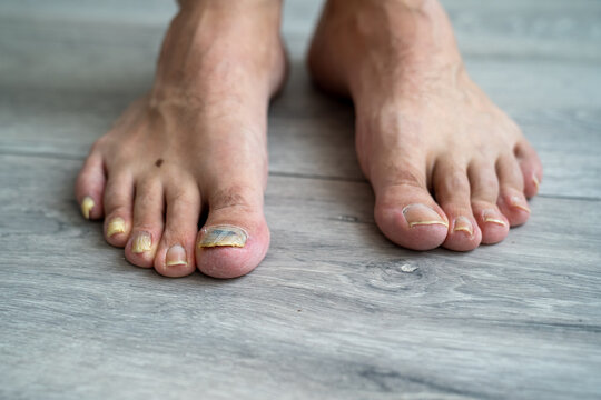 Premium Photo  Fungal nail infection onychomycosis also called