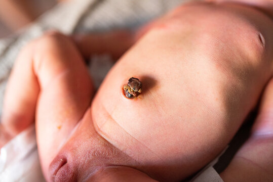 newborn baby belly button healing after birth, navel of little baby belly