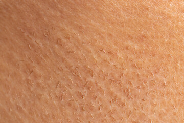 peeling of the skin after an allergic rash