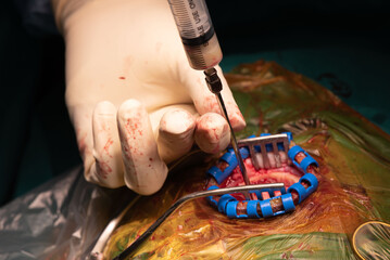 Neurosurgeon aspirating pus from brain abscess - obrazy, fototapety, plakaty