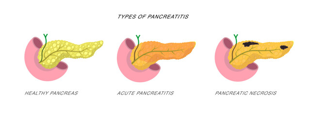 Infographics demonstrating the difference of pancreatitis and pancreatic necrosis Disease diagnostic procedure illustration. 
