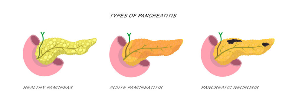 Infographics Demonstrating The Difference Of Pancreatitis And Pancreatic Necrosis Disease Diagnostic Procedure Illustration. 