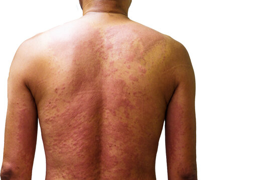 Young man with rash from the drug allergy