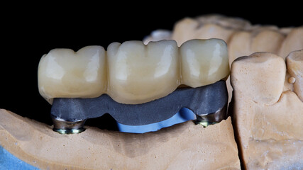 dental bridge prosthesis for three teeth from zircon on a titanium beam