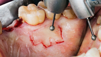 dental nozzle for working with soft tissue during dental implantation