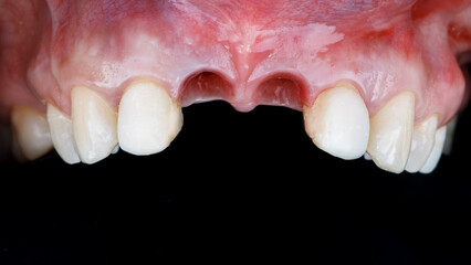 two removed central teeth and installed implants on a black background