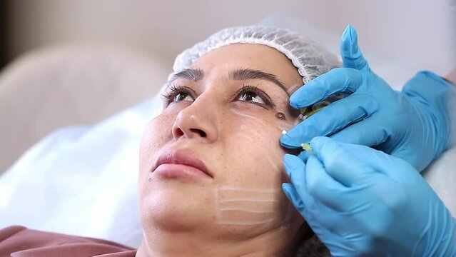Thread lifting is a cosmetological procedure for face rejuvenation. The beautician implants cosmetic threads under the skin to relieve facial ptosis.