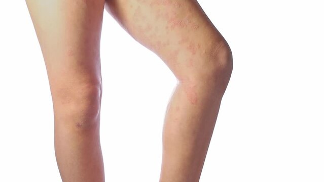 Acute atopic dermatitis on the legs behind the knees of a child is a dermatological disease of the skin. Large, red, inflamed, scaly rash on the legs. Legs of a teenager with severe atopic eczema.