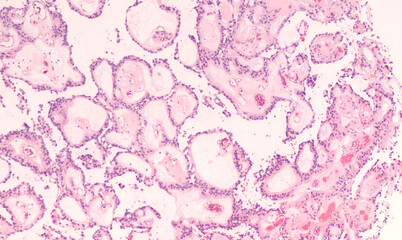 Pathology of a myxopapillary ependymoma, a type of glioma which typically arises in the filum...