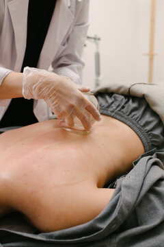 Fire cupping