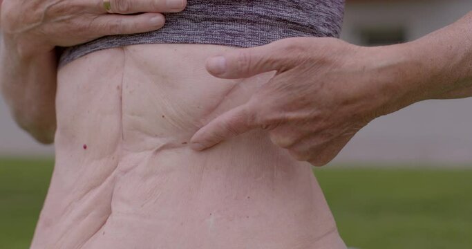60 yo woman shows scar on athletic body, surgery scars due to deadly stomach cancer disease. Life after cancer treatment. Healthy lifestyle outdoor. Becoming more physically active in your everyday