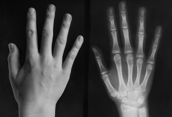 Teen girl's hand next to x-ray