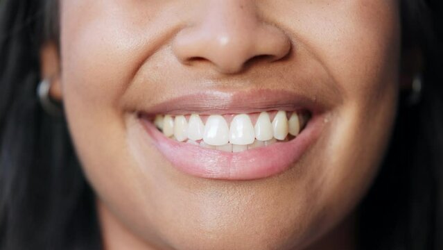 Closeup of smiling ptient showing perfect white teeth with orthodontic invisible braces, teeth whitening treatment or procedure. Headshot of happy woman promoting healthy oral and tooth care routine