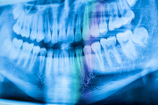 X-ray image of a boy's teeth, Side view of a boy's front x-ray.