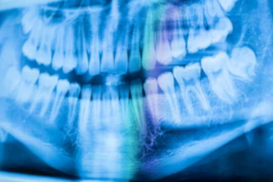 Blurry image for background of X-ray image of a boy's teeth, front view of a boy's front x-ray.