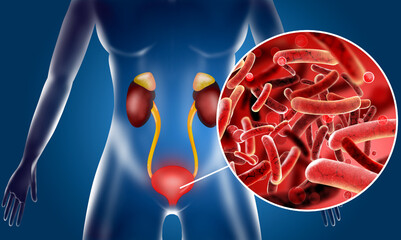 Illustration of woman suffering from cystitis. Urinary infection