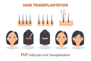 Stages of woman hair transplantation FUT Follicular Unit. Treatment surgery of baldness, alopecia, hair loss. Vector medical infographics, a female head scalp. Strip, graft machine. - obrazy, fototapety, plakaty