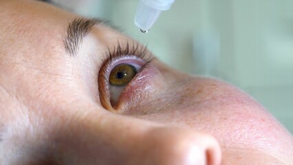 The eyes of a young woman. At the doctor. Instillation into the eyes. Treatment of eye diseases....