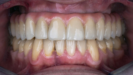 Fototapeta premium finished prosthesis made of ceramics and titanium in the cavity of the patient's upper jaw