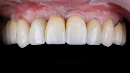 installed dental ceramic crown in the deuce area - obrazy, fototapety, plakaty