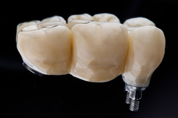 dental prosthesis bridge for three teeth from zircon on a black background