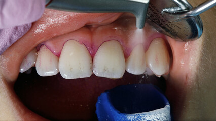 dental moment of upper jaw hygiene with glycerin and modern dental equipment © Dental Pro Content