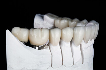 Fototapeta na wymiar dental model of the lower jaw with ceramic crowns and veneers on a black background
