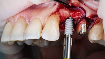 dental moment of implant insertion without a template in the upper jaw