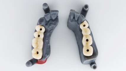 two dental models with posterior bridges, top view on a white background