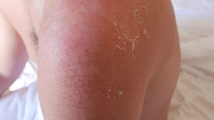 Sunburn: Closeup of Peeling sunburned skin on back and shoulder. Skin peels off after the strong sun. Red inflamed skin from sun rays.