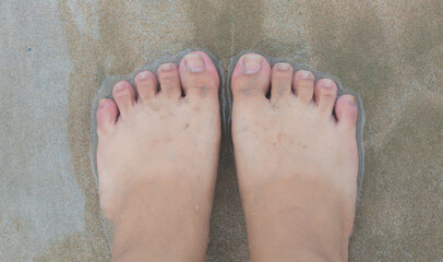 Sunburn feet on the sandy beach