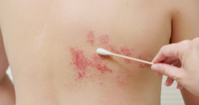 man with shingles disease