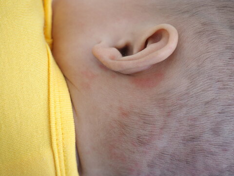 Newborn baby neck red rash. Closeup photo, blurred.